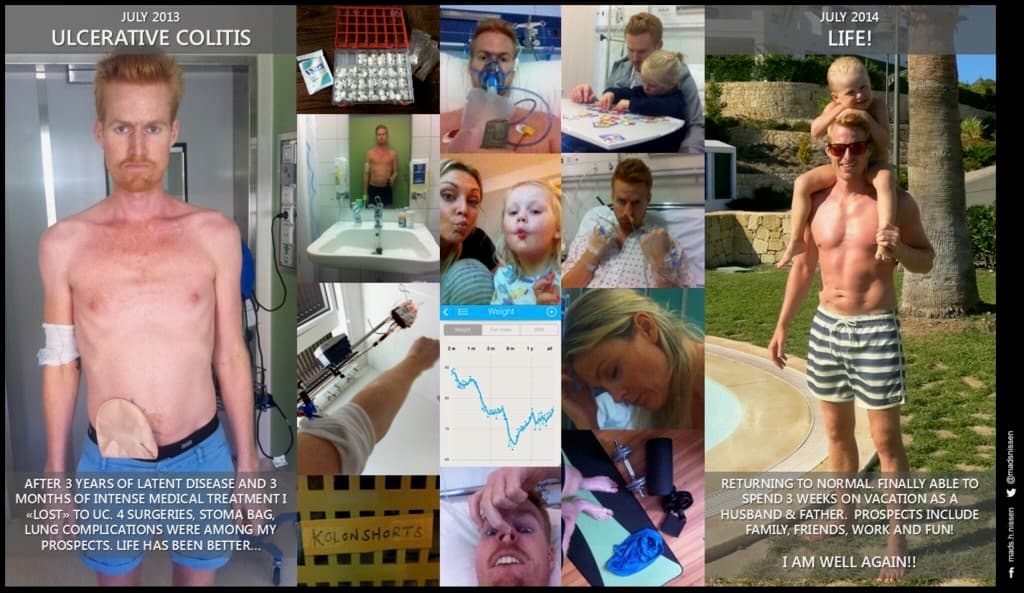 Recovery from ulcerative colitis — July 2013 hospital and surgeries to July 2014 back with family. The turning point that re-based everything.